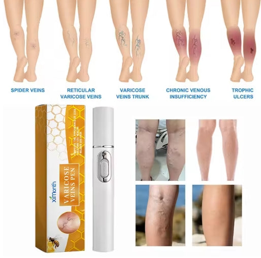 Varicose Vens Pen Repair Vasculitis Phlebitis Soothe Skin Relieve Varicose Feet Blood Vessel Blockage Body Health Care