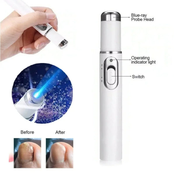 Nail Fungus Treatment Pen Anti-fungal Repair Pen Blue Light Laser Pen Paronychia Nail Onychomycosis Painless Removal Care