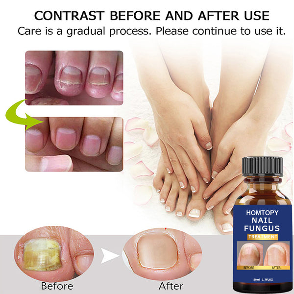 3Pcs Nail Fungus Treatments Liquid Serum Anti-Infection Onychomycosis Paronychia Hand Care Nails Foot Fungal Removal Liquid