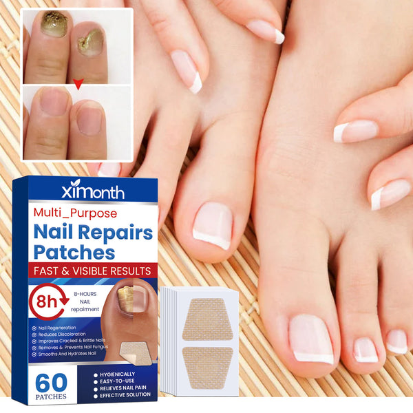 60pcs Toenail Fungus Treatment Stickers Ingrowning Toenail Corrector Paronychia Repair Patch Fungus Removal Nail Repair Patch
