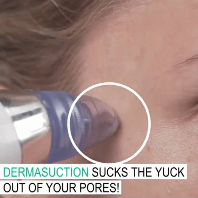 Electric Blackhead Remover and Pore Cleanser for Facial Beauty and Exfoliation